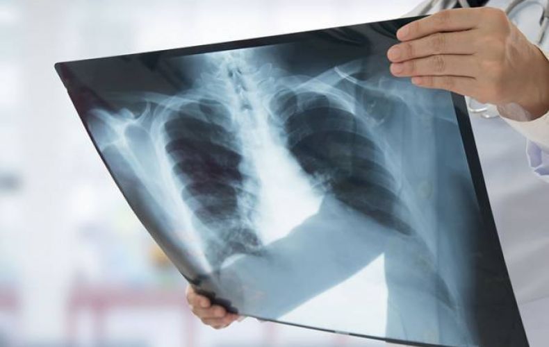 Инициатива “Аврора” предоставит больницам Армении 10 аппаратов искусственного дыхания легких
