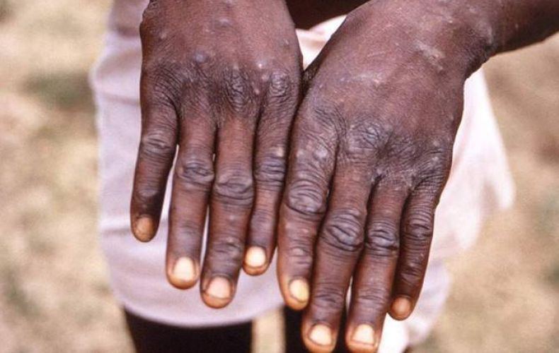 Monkeypox cases rise to more than 3,400 globally, WHO says